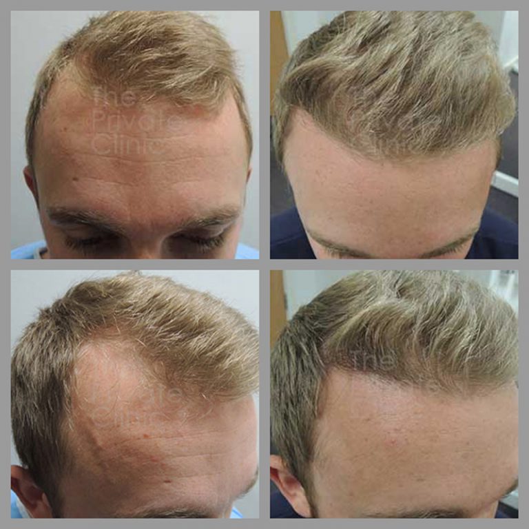 Hair Transplant Near Me Best Hair Transplant Uk Male Hair Transplant