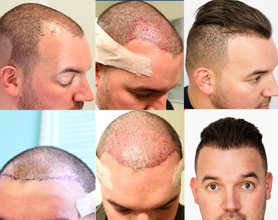 Hair Transplant FUE Procedure Before And After Photos Hair Restoration Doug 