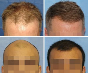 hair transplant before and after crown temple area photos