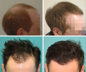 hair transplant FUE before and after photo