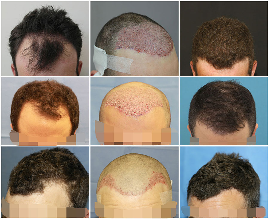 Hair Transplants Before During After The Private Clinic Web 