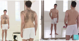 laser hair removal men before after photo