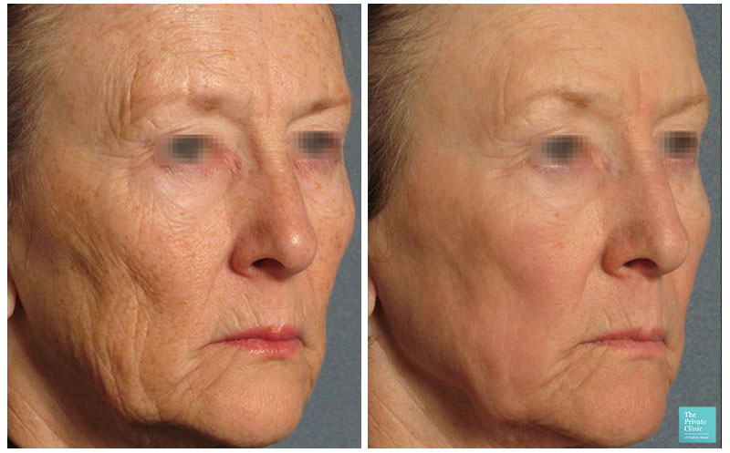 Can deep wrinkles be treated as easily as fine lines? The best treatments •  Illuminate Skin Clinics