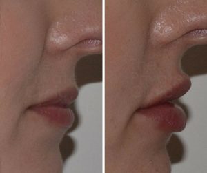 lip-fillers-results-300x251.jpg