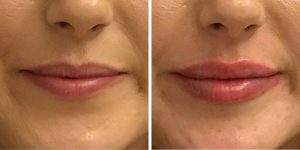 Before and After Lip Filler with The Private Clinic