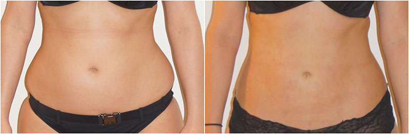 Liposuction of the 'love handles' or flanks