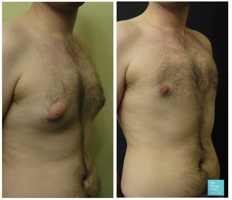 Increase in men with man boobs having breast reduction surgery