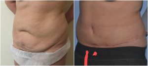 abdominoplasty tummy tuck before after photos