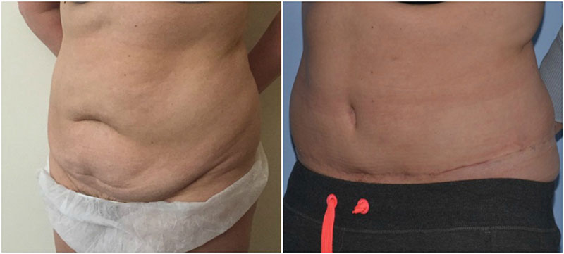 What to expect after tummy tuck surgery, How long is tummy tuck