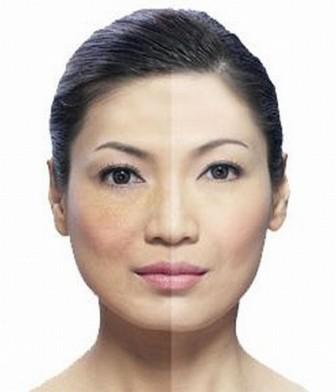 Melasma Treatments at The Private Clinic