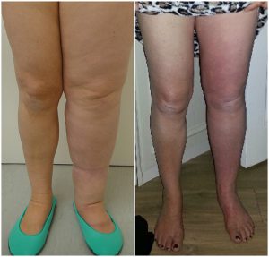 microlipo-lymphoedema-before-after-the-private-clinic-web