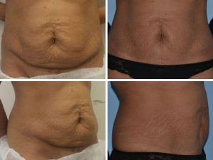 mini abdominoplasty before and after photo