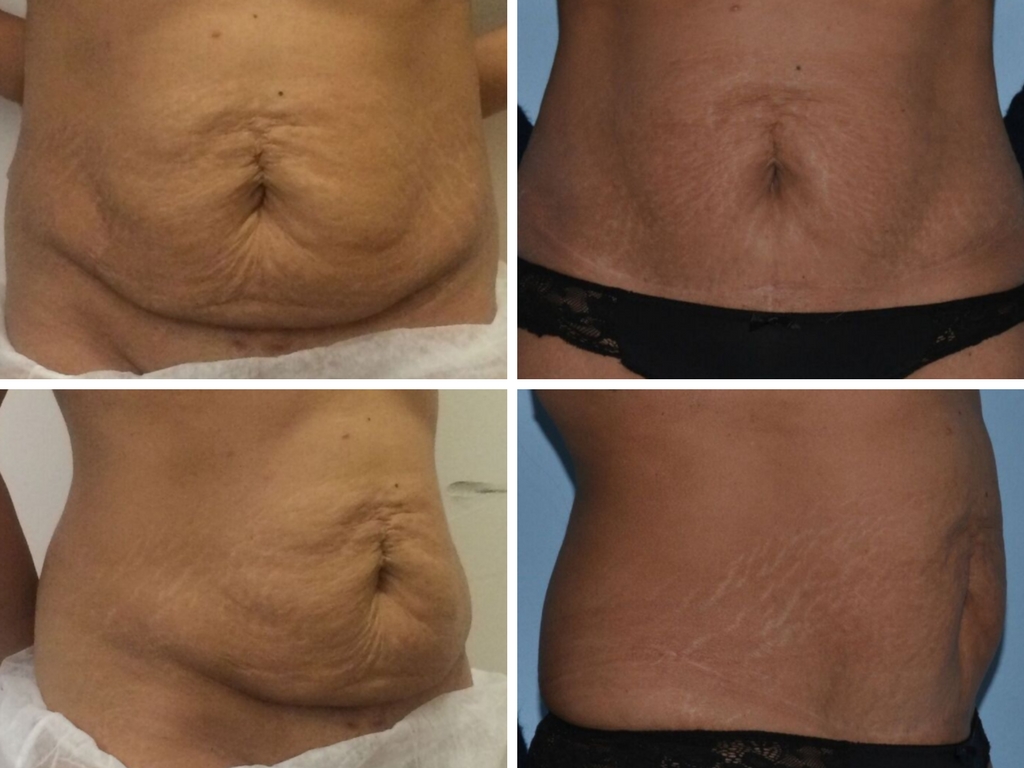 mini tummy tuck before and after nyc
