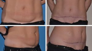 mini tummy tuck before and after photo