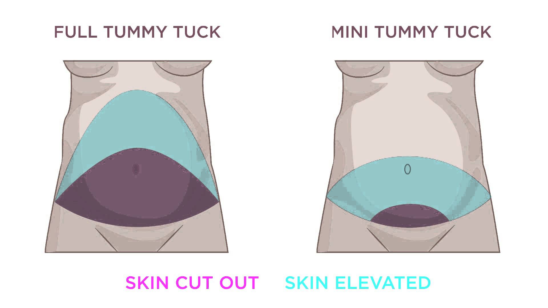 mini tummy tuck recovery swelling