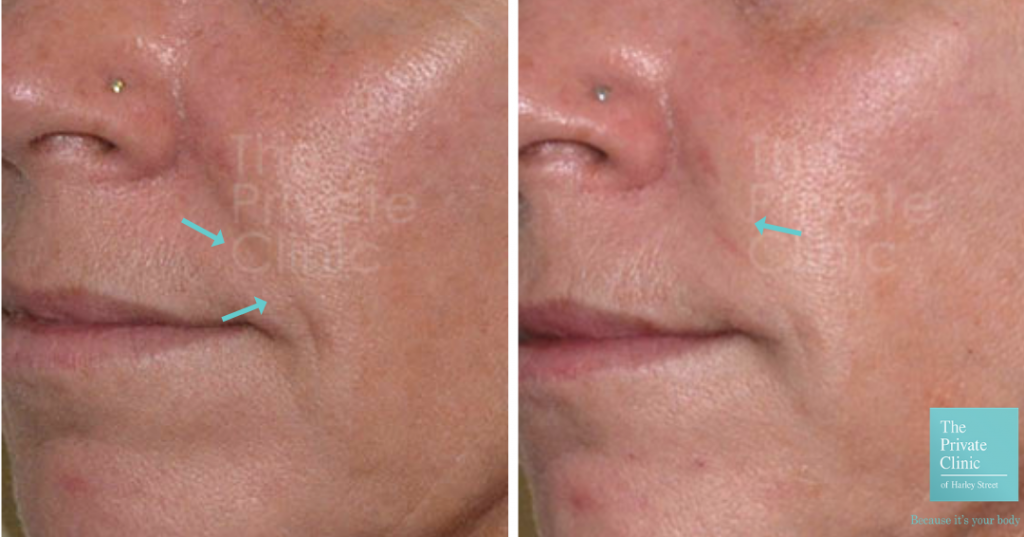 Nasolabial folds dermal filler Before and after photo