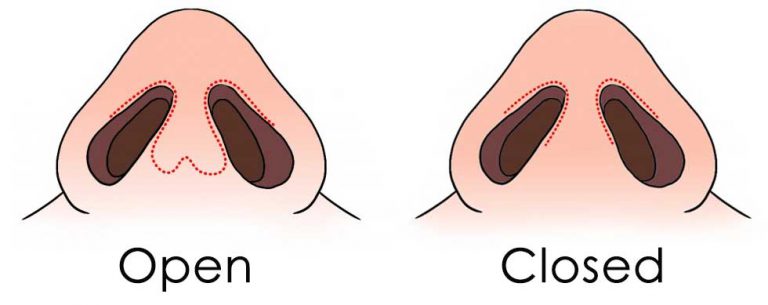 rhinoplasty-or-nose-job-procedure-rhinoplasty-experienced-surgeon