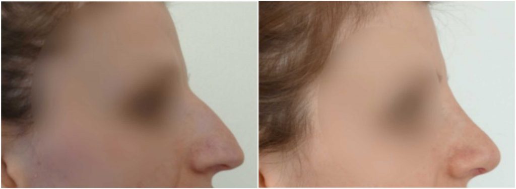 rhinoplasty-before-after-the-private-clinic-WEB