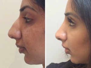 revision rhinoplasty before and after photo results