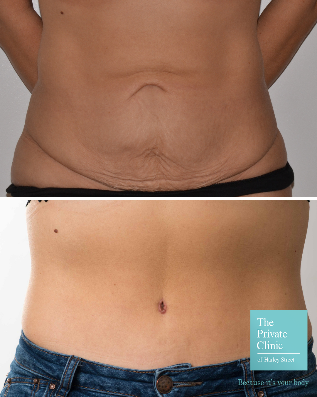 Liposuction vs. Tummy Tuck Surgery : procedure, before and after