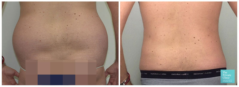 Love Handles Before and After Photos, Non-Surgical treatment for love  handles reduction