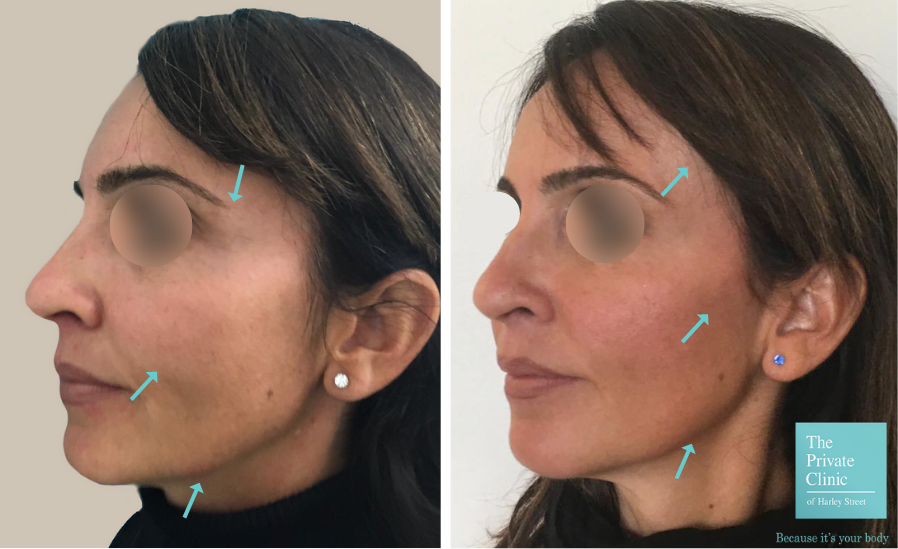 Best non-surgical Facelift 2024, non-invasive Face tightening