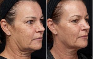 Before and After a Thermage Treatment