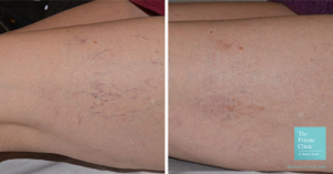 thread veins before and after photo london