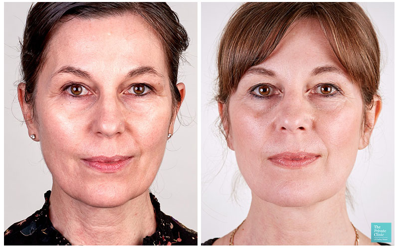 Best Non surgical Facelift 2024 Non invasive Face Tightening Procedures