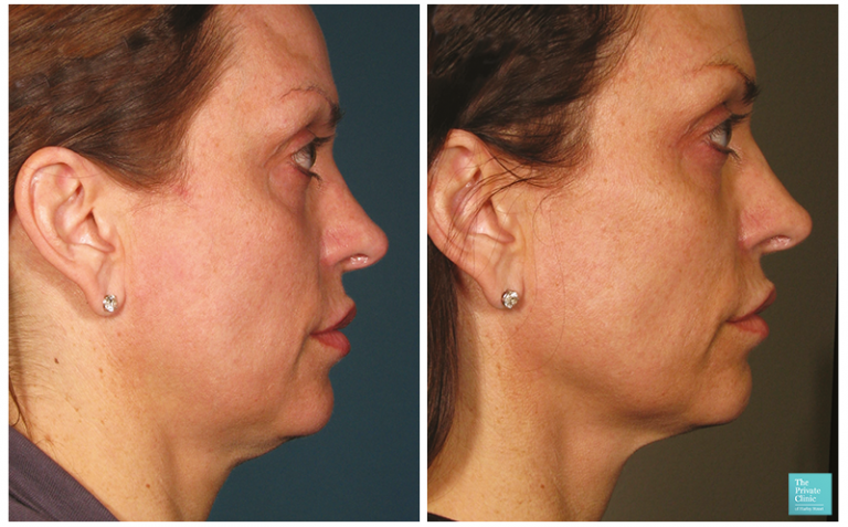 Sagging Jowls treatment | Liposuction for sagging jowls and double chin