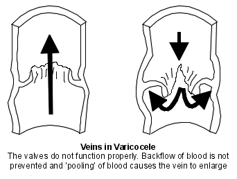 varicose veins scrotum testicle infertility varicoceles
