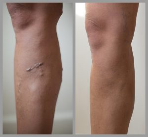 varicose vein removal surgery evla before after photos