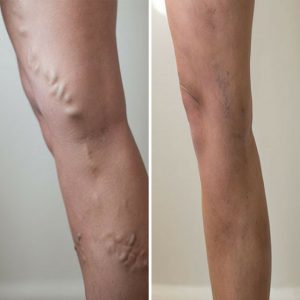 varicose vein removal leg uk before and after photo