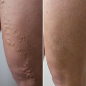 varicose vein removal leg upper thigh before after photo