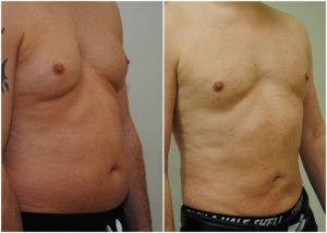 vaser-lipo-before-after-dr-anthony-the-private-clinic-web