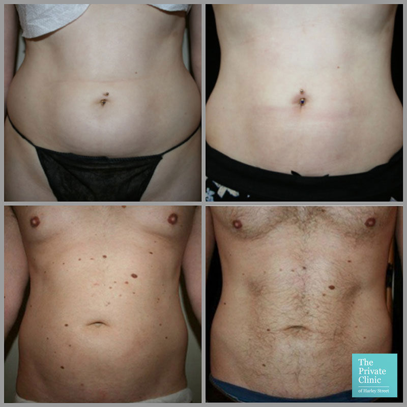 Non-Invasive Liposuction, freezing fat cells, Stomach Liposuction