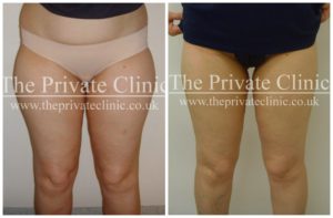 vaser liposuction female thighs before and after photos